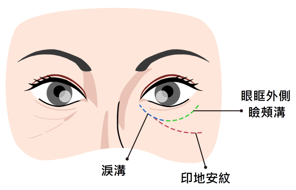 瞼頰溝與淚溝的位置
