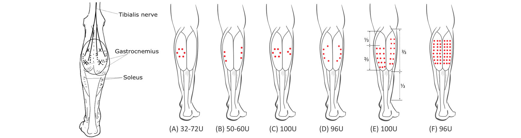 肉毒小腿注射位置分布比較