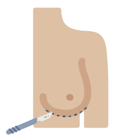 隆乳植入物切口位置-乳下緣