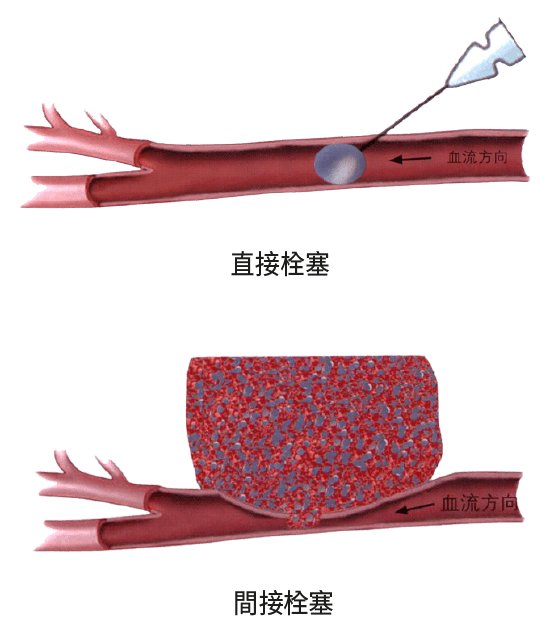 玻尿酸失敗-血管直接栓塞與間接栓塞