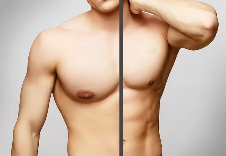 男性女乳症手術-4D胸廓塑型術