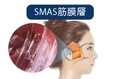 海芙音波筋膜層SMAS