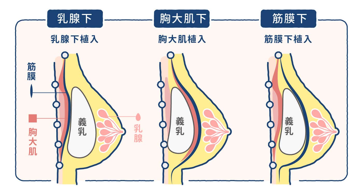 隆乳位置選擇-隆乳放置位置圖