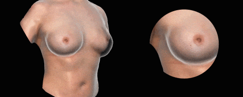 LifeViz 3D隆乳模擬系統-尺寸變化