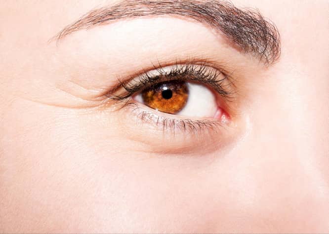 眼眶隔膜失去緊緻彈性，會使後方的脂肪凸出造成真性眼袋