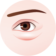 眼袋形成原因-脂肪型眼袋