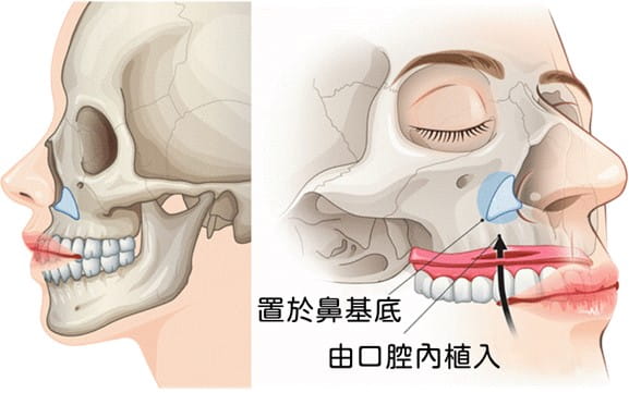 鼻基底手術植入墊片位置