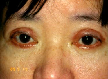 割眼袋後遺症–疤痕增生肥厚或攣縮